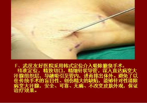 目前腋臭根治技术推广情况报告
