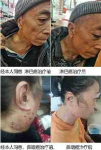 尿毒症乳腺癌不讲价钱凭良心给广西百色杨忠雅